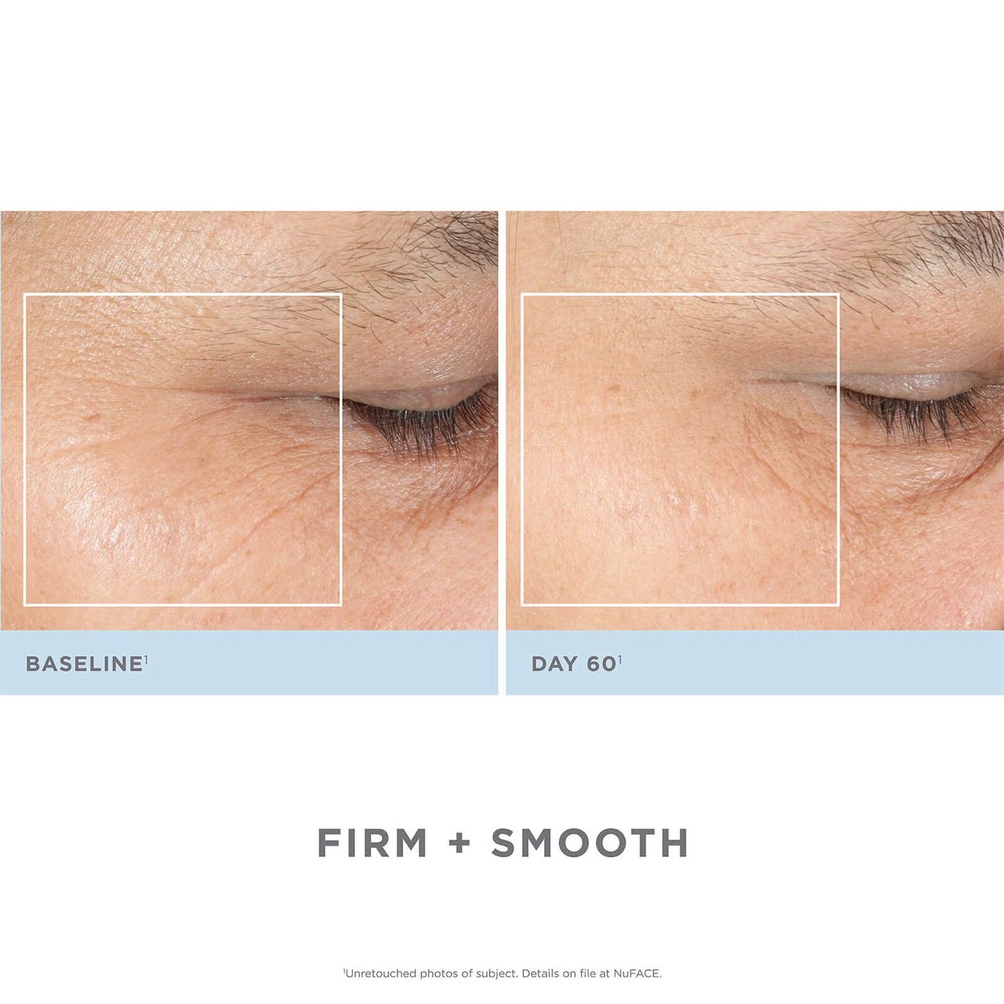 NuFACE Trinity Complete Facial Toning Kit