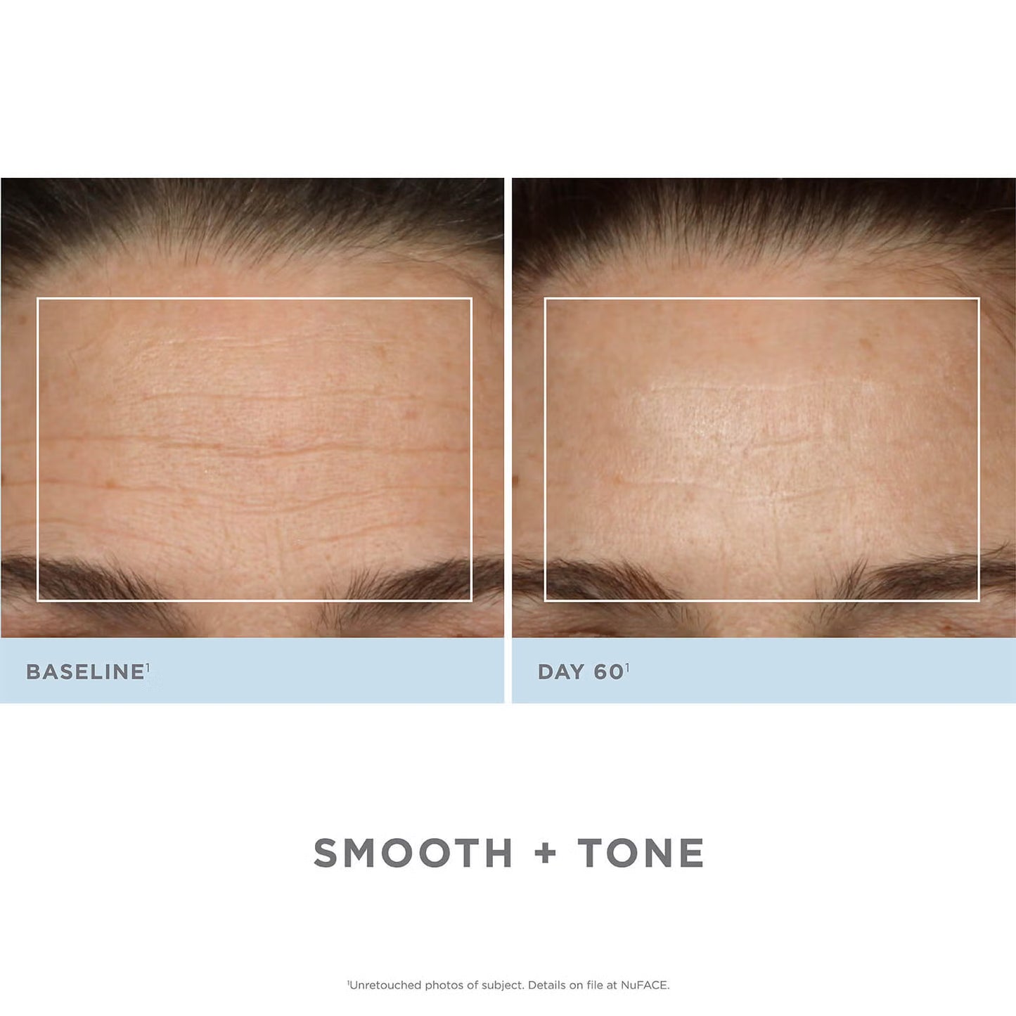 NuFACE Trinity Complete Facial Toning Kit