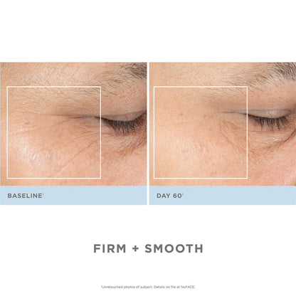 NuFACE Trinity Complete Facial Toning Kit