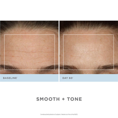 NuFACE Trinity Complete Facial Toning Kit